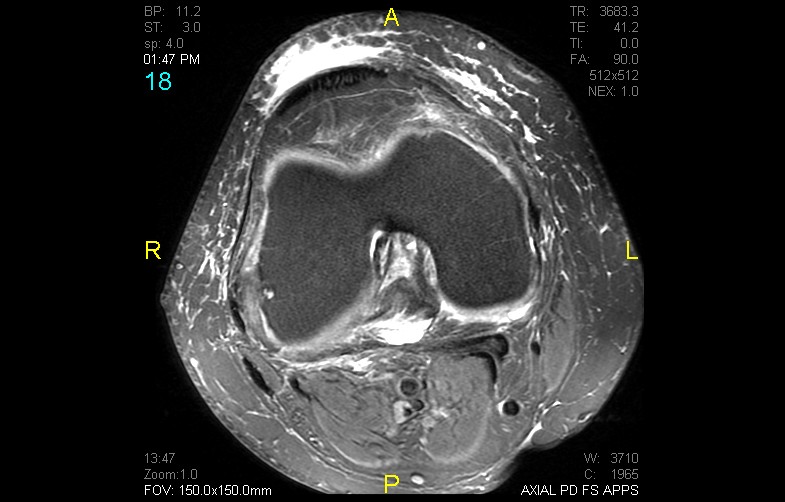 Figure 6 for case Popliteus tendinosis